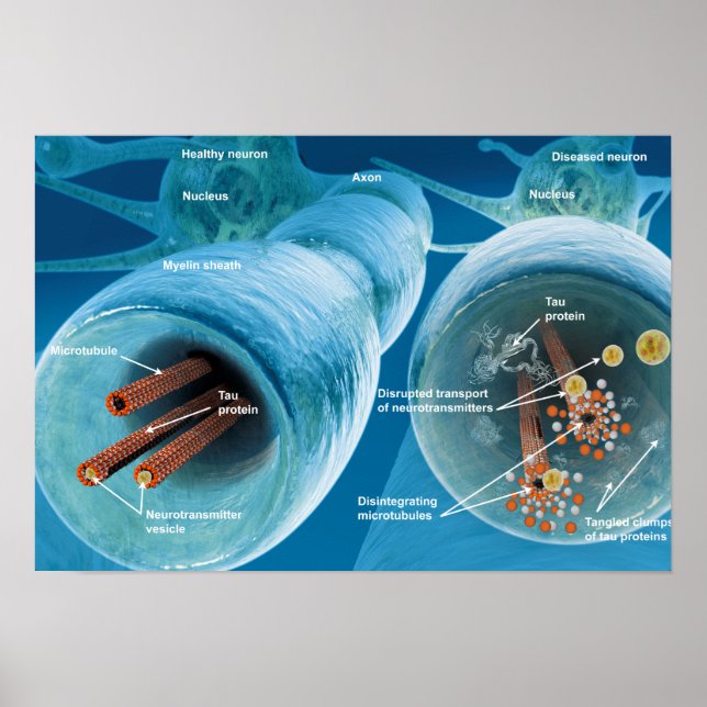 Desintegration der Mikrotubuli in einem Neuron Poster (Vorne)