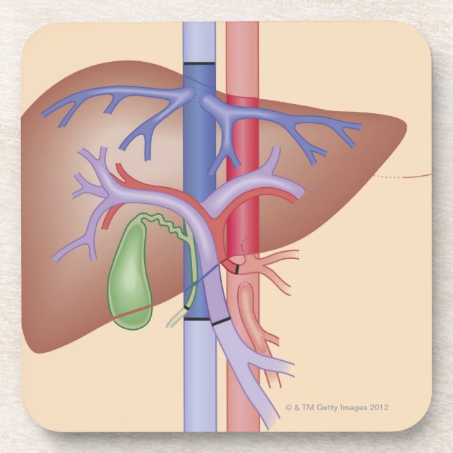 Dessous-de-verre Procédure de greffe de foie (Devant)