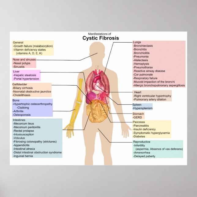 Detaillierte Darstellung der Symptome der zystisch Poster (Vorne)