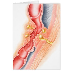Développement De La Fistule