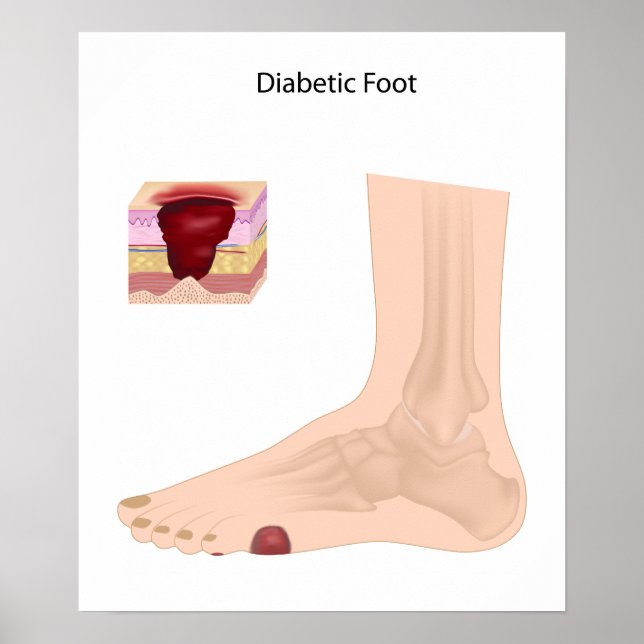 Diabetisches Foot Poster (Vorne)