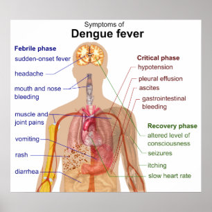 Diagramm der Hauptsymptome des Dengue-Fiebers Poster