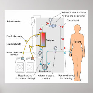 Diagramm eines Hämodialyseärztlichen behandlung Poster