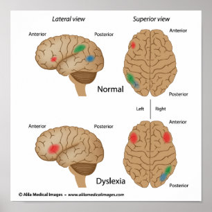Dyslexie Gehirnaktivität Poster