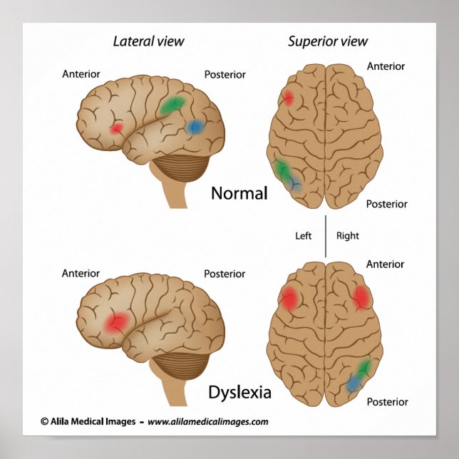 Dyslexie Gehirnaktivität Poster (Vorne)