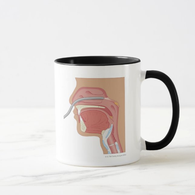 Endoskopie der Nase Tasse (Rechts)