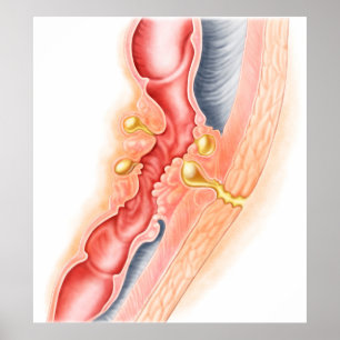 Entwicklung der Fistel Poster
