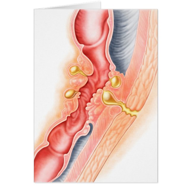 Entwicklung der Fistula (Vorne)