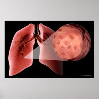 Entzündete Atemwege während eines Asthmaanfalls