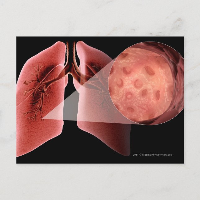 Entzündete Atemwege während eines Asthmaanfalls Postkarte (Vorderseite)