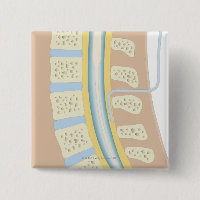 Epidurale Anästhesie