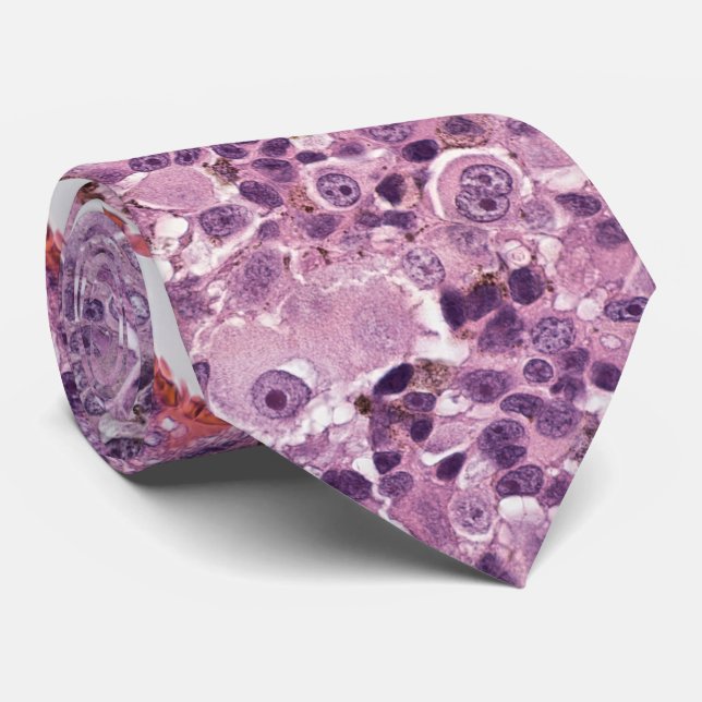 Epithelioid uveal melanoma krawatte (Gerollt)