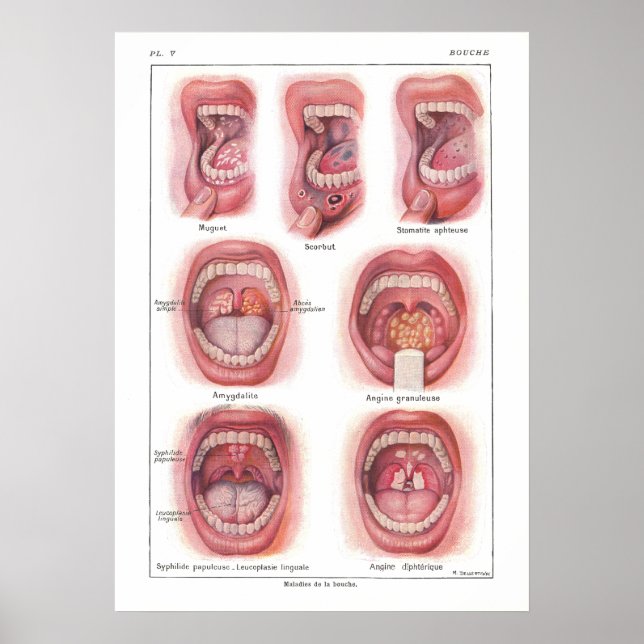 Erkrankungen der Mundanatomie Poster Französisch (Vorne)