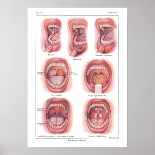 Erkrankungen der Mundanatomie Poster Französisch