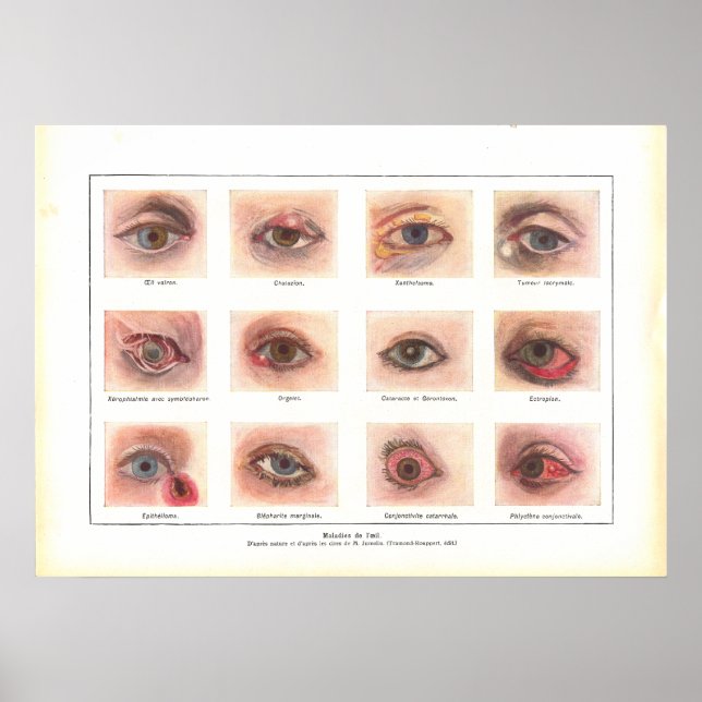 Erkrankungen des Augenanatomie Poster Französisch (Vorne)