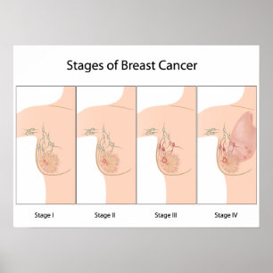 Étapes du cancer du sein Poster