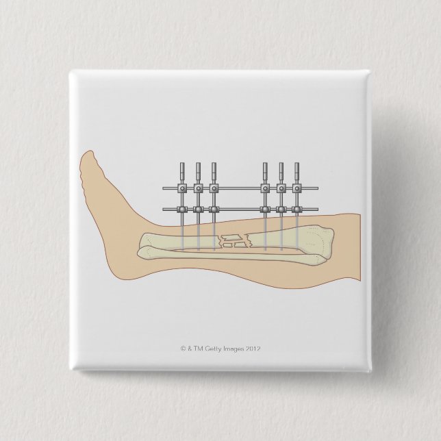 Externer Fixator Button (Vorderseite)