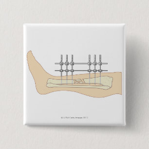 Externer Fixator Button