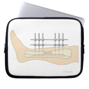 Externer Fixator Laptopschutzhülle