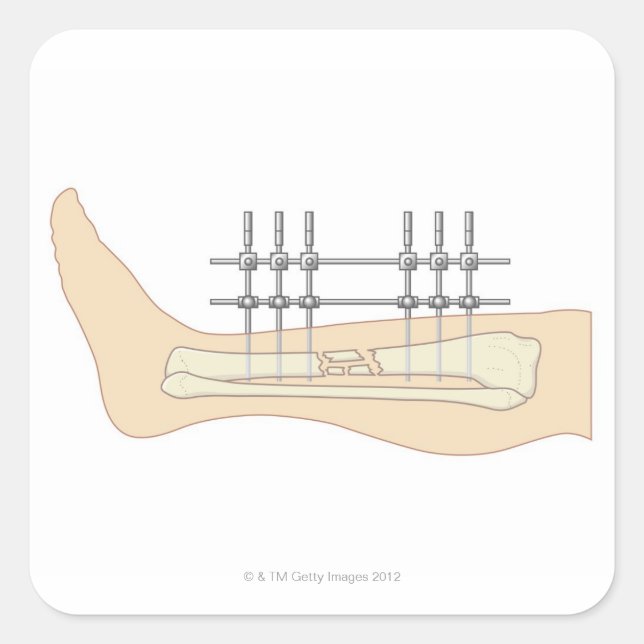 Externer Fixator Quadratischer Aufkleber (Vorderseite)