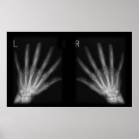 Extra-Digit-Röntgen-rechte und Links Hände