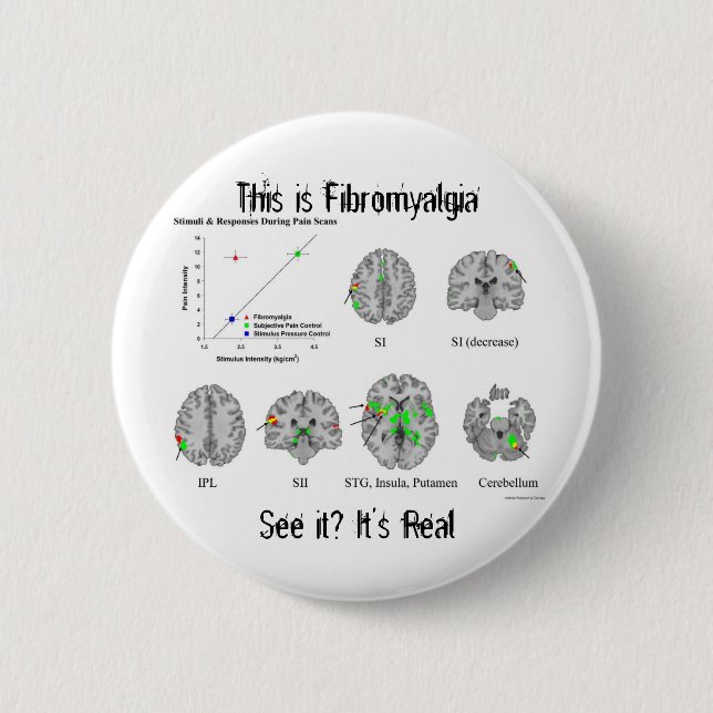 Fibromyalgia ist wirklich. fMRI Beweis Button (Vorderseite)