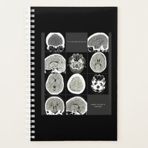 FullCTScan_thisiswhat depressionsions like Planer