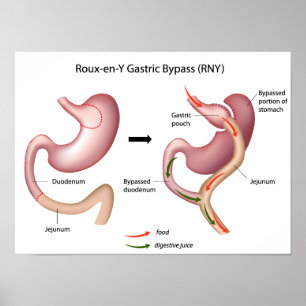 gastrisches Operationsplakat der Überbrückung Poster