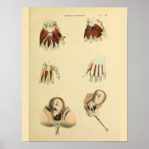 Geburtszange Geburtshilfe Anatomie Medizin Kunst D Poster