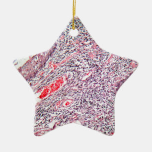 Gewebezellen von einem menschlichen Hals mit Krebs Keramik Ornament