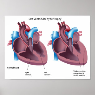 Heart hypertrophy Poster