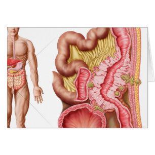 Illustration de diverticulose dans les deux points