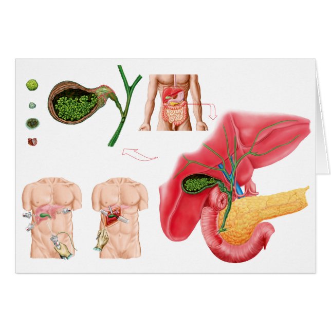 Illustration der Cholektomie (Vorderseite (Horizontal))