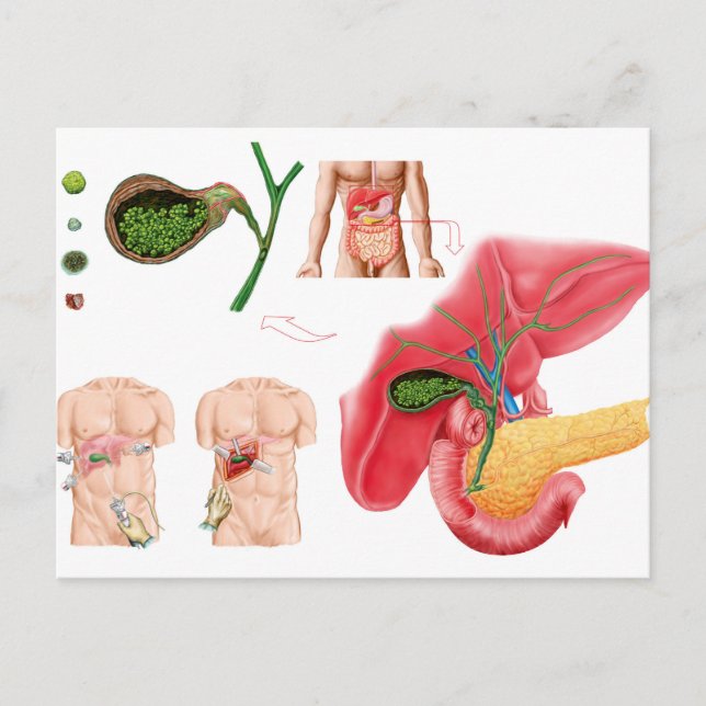 Illustration der Cholektomie Postkarte (Vorderseite)