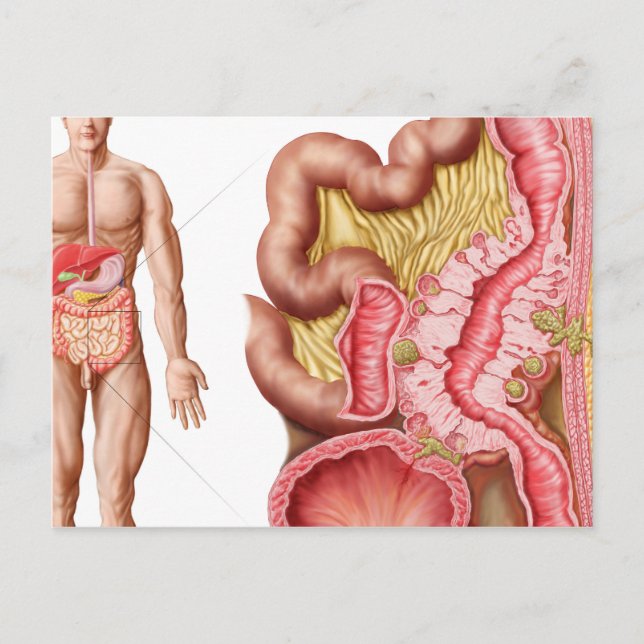 Illustration der Divertikulose im Kolon Postkarte (Vorderseite)