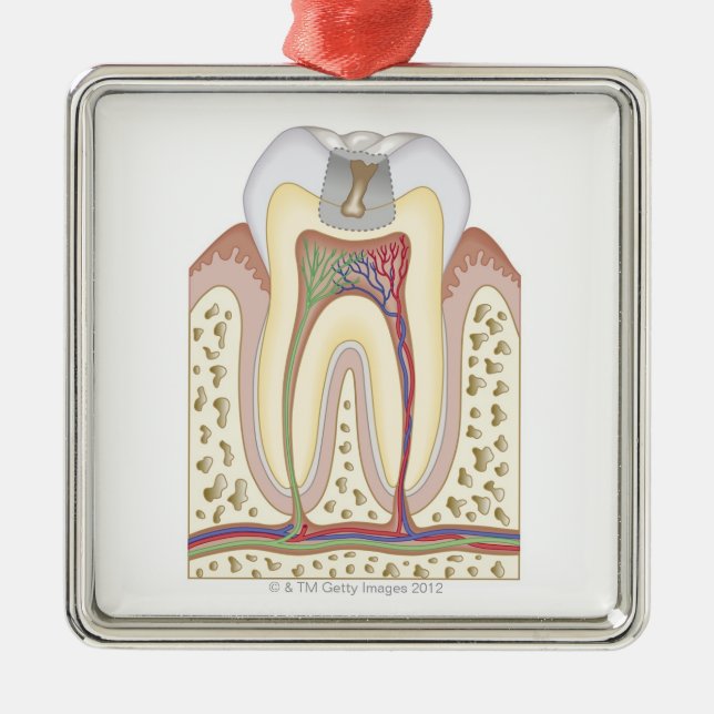 Illustration des Zahnverfalls Silbernes Ornament (Vorne)
