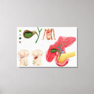 Illustration, die Cholecystectomy darstellt Leinwanddruck