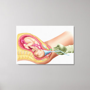 Illustration, die Lieferung von Fötus 1 zeigt Leinwanddruck