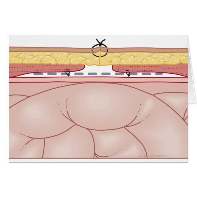 Illustration d'une hernie (Devant horizontal)