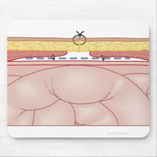 Illustration einer Hernie Mousepad