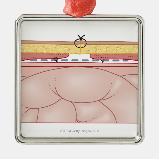 Illustration einer Hernie Silbernes Ornament (Vorne)