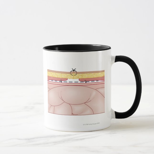 Illustration einer Hernie Tasse (Rechts)