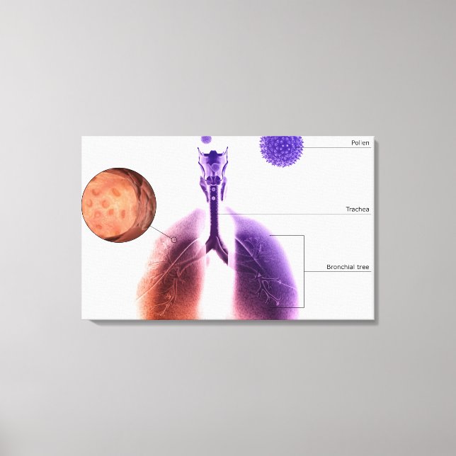 Illustration eines Asthmaanfalls von Pollen Leinwanddruck (Vorderseite)
