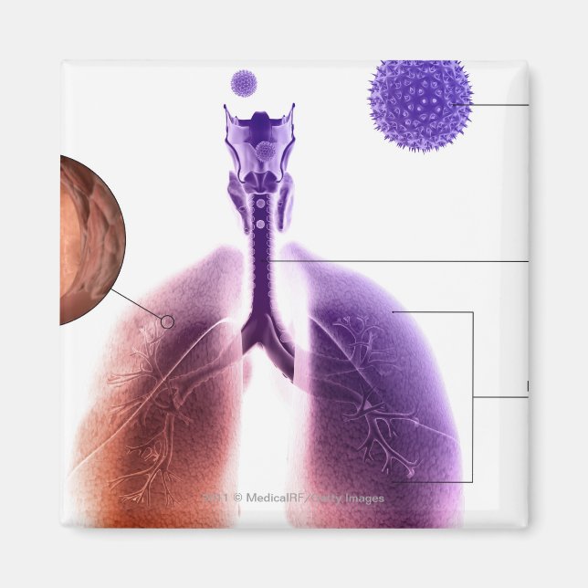 Illustration eines Asthmaanfalls von Pollen Magnet (Vorne)