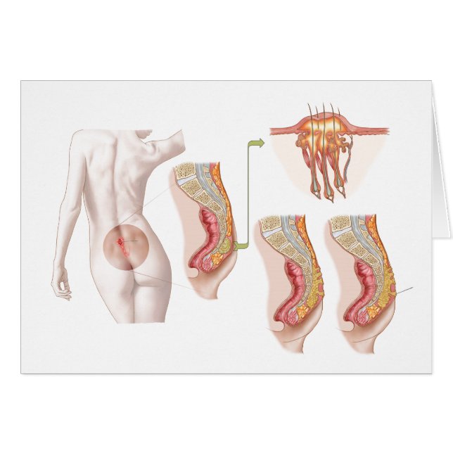 Illustration Médicale D'Un Cyst Pilonidal (Devant horizontal)