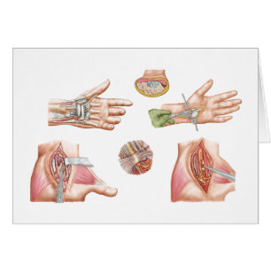 Illustration Médicale montrant le canal carpien