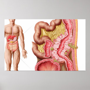 Illustration von Diverticulosis im Doppelpunkt Poster