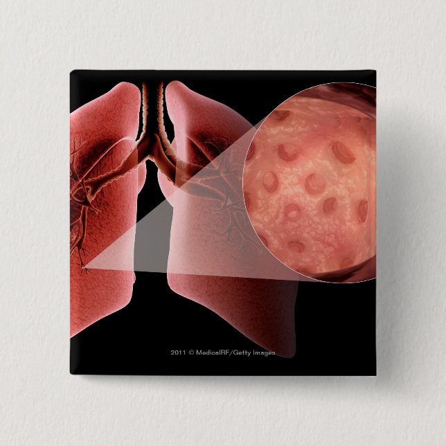 Inflammed Fluglinie während eines Asthmaanfalls Button (Vorderseite)