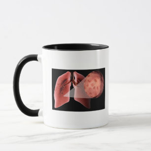 Inflammed Fluglinie während eines Asthmaanfalls Tasse