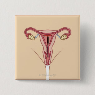 Intrauterines Gerät Button